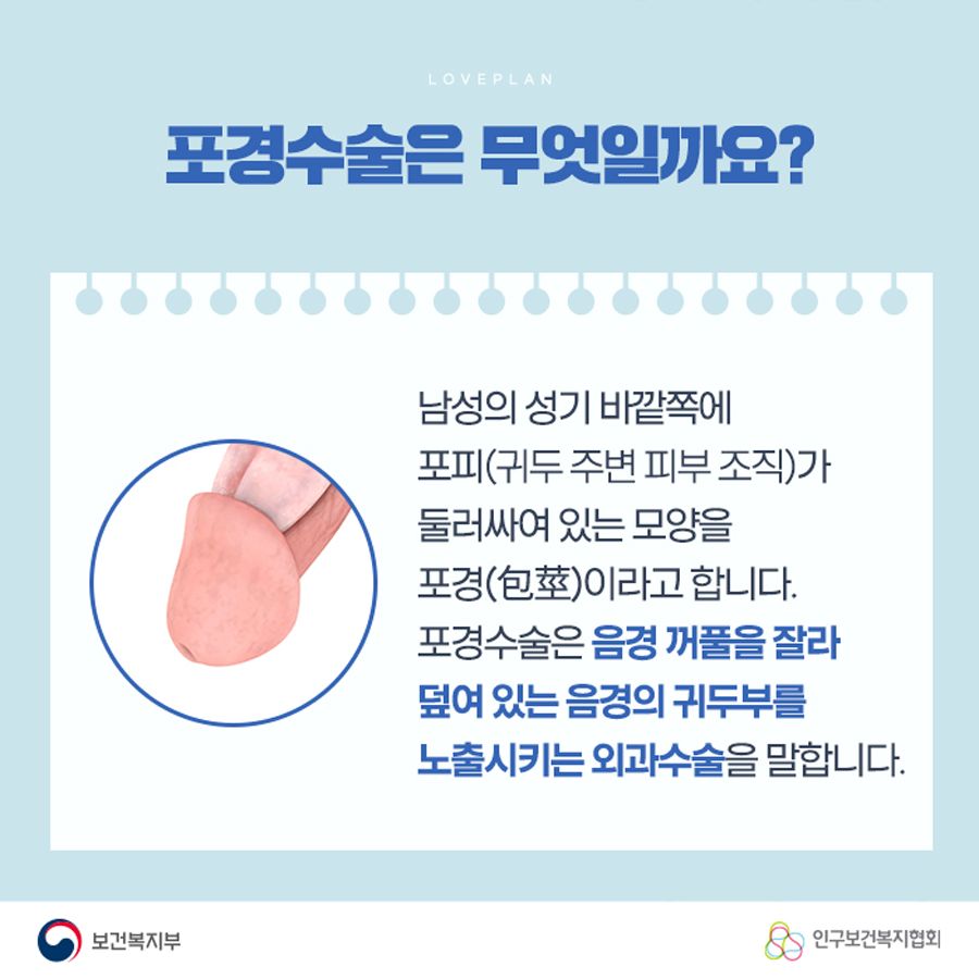 포경수술은 무엇일까요? 남성의 성기 바깥쪽에 포피(귀두 주변 피부 조직)가 둘러싸여 있는 모양을 포경이라고 합니다. 포경수술은 음경 꺼풀을 잘라 덮여 있는 음경의 귀두부를 노출시키는 외과수술을 말합니다.