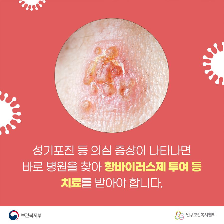 성기포진 등 의심 증상이 나타나면 바로 병원을 찾아 항바이러스제 투여 등 치료를 받아야 합니다.