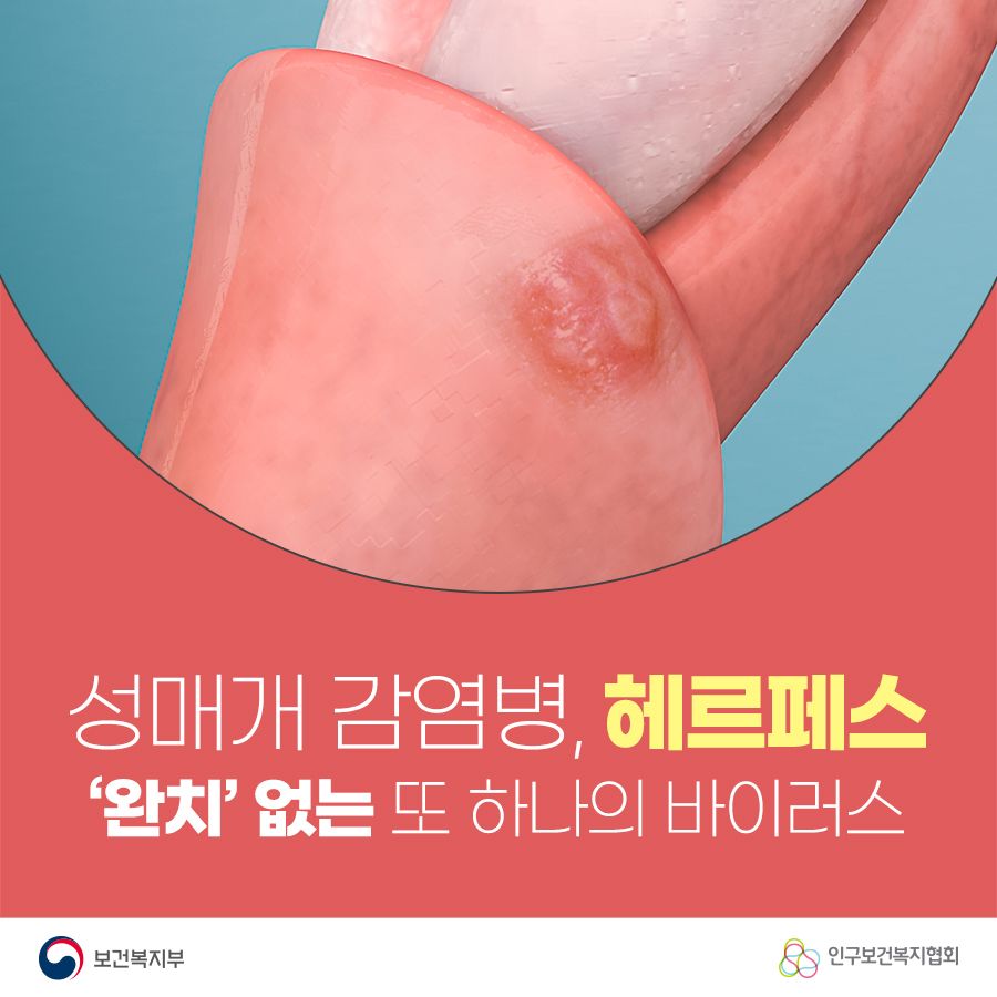 성매개 감염병, 헤르페스! '완치'없는 또 하나의 바이러스