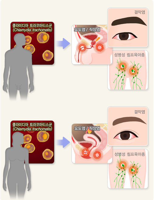 클라미디아 트라코마티스균이 요도염, 직장염, 결막염, 성병성 림프육아종을 발생시킨다.